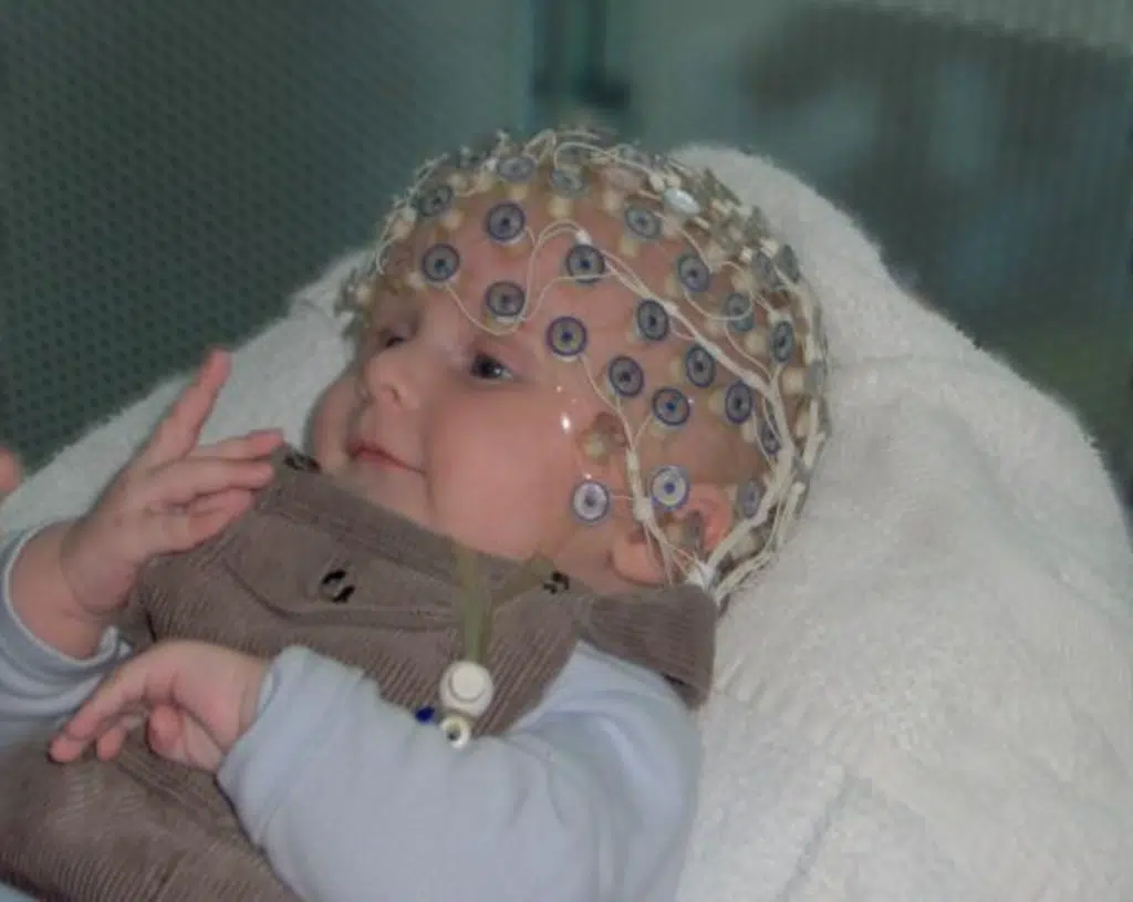 mort subite et inexpliquée du nourrisson