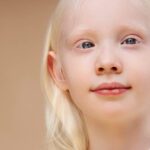 [Chronique dans le noir] L’albinisme, handicap ou maladie ?
