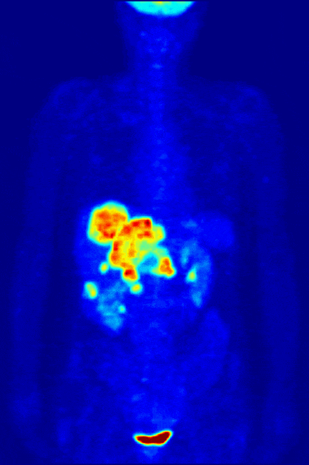 Reconstruction tridimensionnelle de la distribution de glucose marqué au fluor 18 telle que mesurée par tomographie d'émission de positons.
